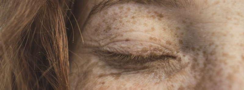 International Skin Pigmentation Day